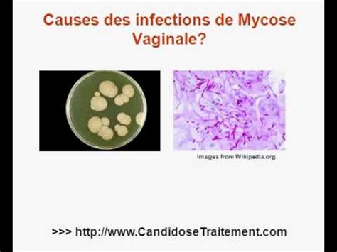 Mycose et pertes vaginales : symptômes, causes et。